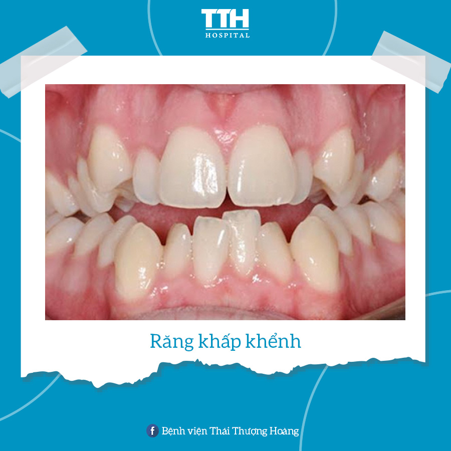 Răng khấp khểnh là tình trạng răng mọc lộn xộn, sai lệch về vị trí, phương và chiều so với răng bình thường