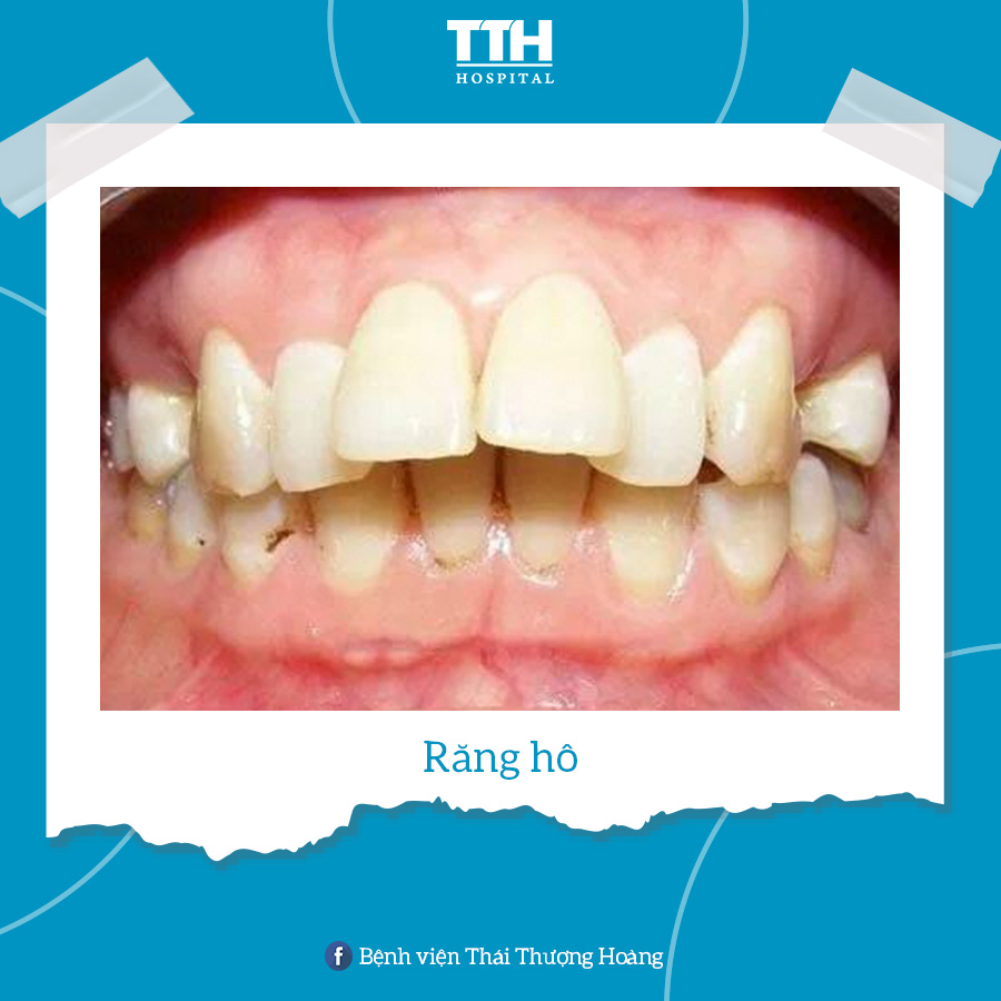 Răng hô là tình trạng răng hàm trên nằm quá xa về phía trước so với răng hàm dưới