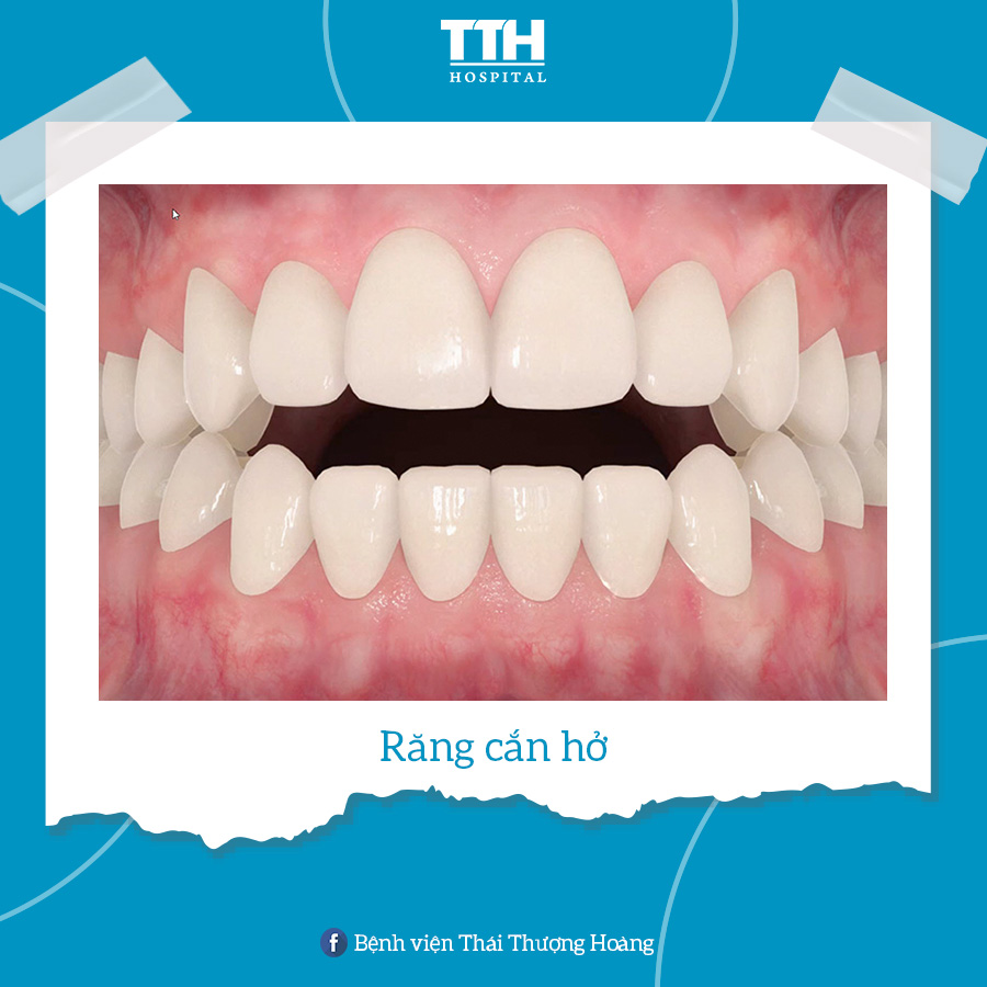 Răng cắn hở là tình trạng phần răng cửa trên và phần răng cửa dưới không chạm nhau khi cắn hai hàm lại mà có một khoảng cách giữa 2 hàm