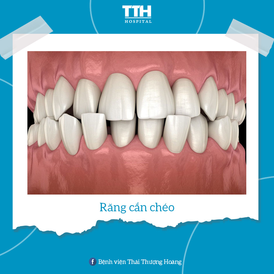 Răng cắn chéo là tình trạng răng trên và răng dưới không thẳng hàng nhau