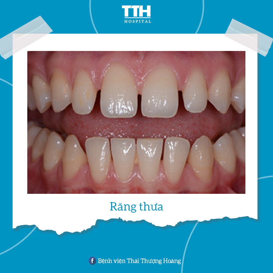 Răng thưa là việc xuất hiện các khoảng trống giữa hai hoặc nhiều răng