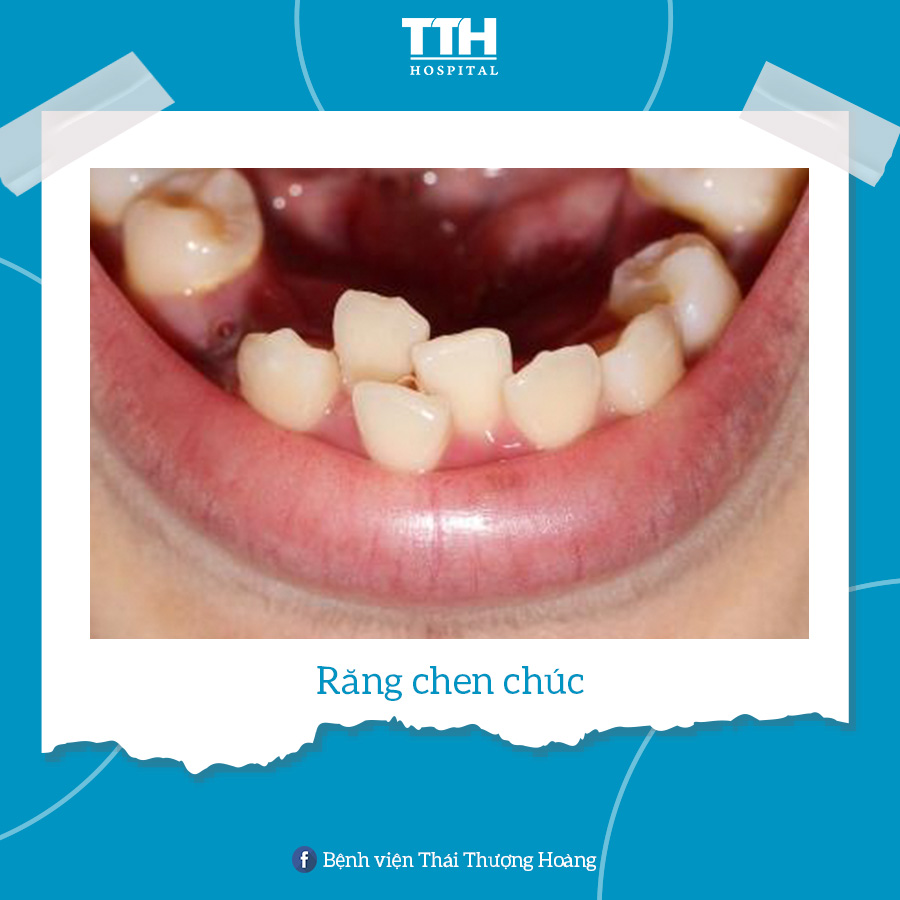 RĂNG CHEN CHÚC (CROWDED TEETH)