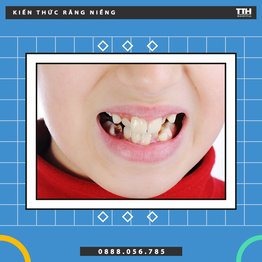 Răng lệch lạc ở trẻ có rất nhiều nguyên nhân như di truyền, thói quen xấu hay chấn thương răng
