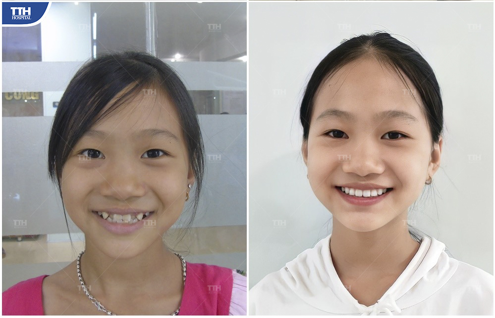 Kết quả niềng răng của Khách hàng 3 tại bệnh viện Thái Thượng Hoàng