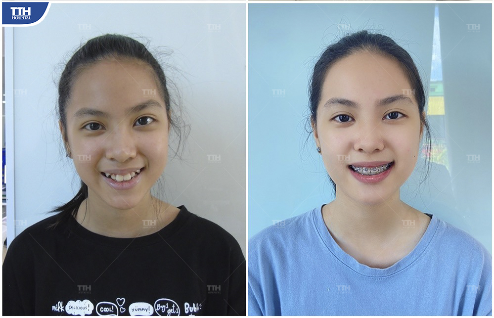Kết quả niềng răng của Khách hàng 4 tại bệnh viện Thái Thượng Hoàng