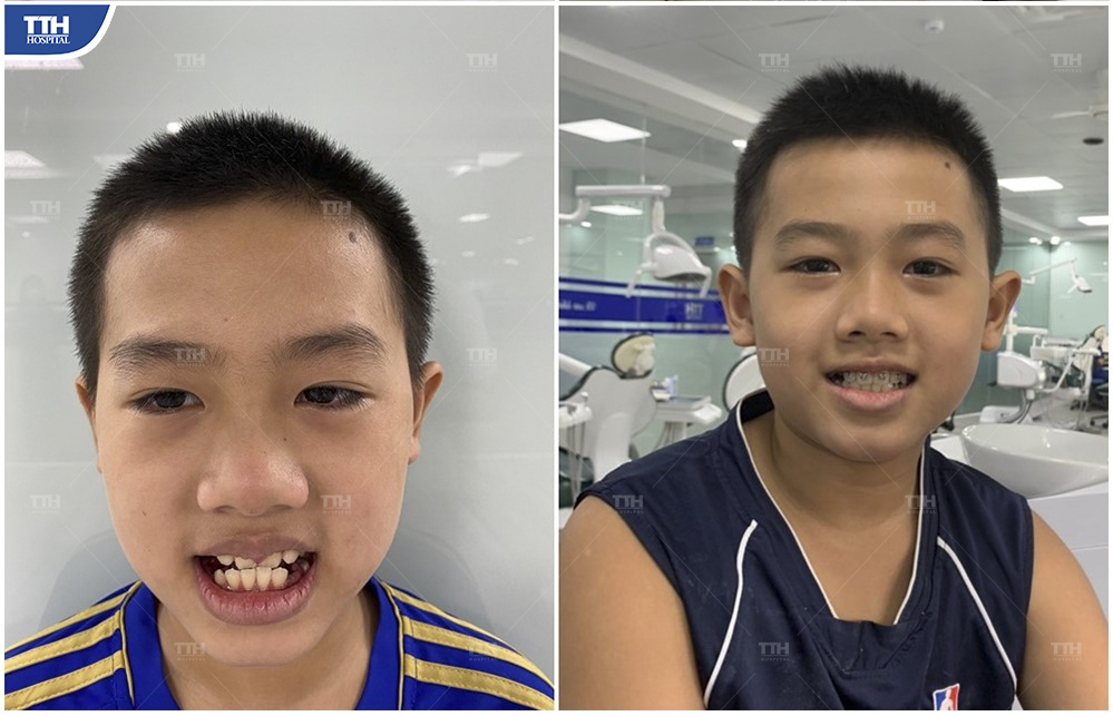 Kết quả niềng răng của Khách hàng 5 tại bệnh viện Thái Thượng Hoàng