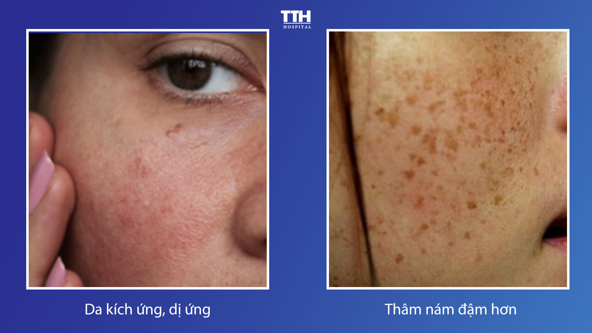 HẬU QUẢ NGHIÊM TRỌNG KHI ĐIỀU TRỊ NÁM SAI CÁCH