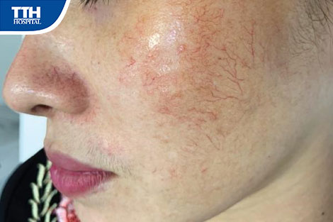 Điều trị nám sai cách khiến da bị bào mòn, dẫn đến giãn mao mạch