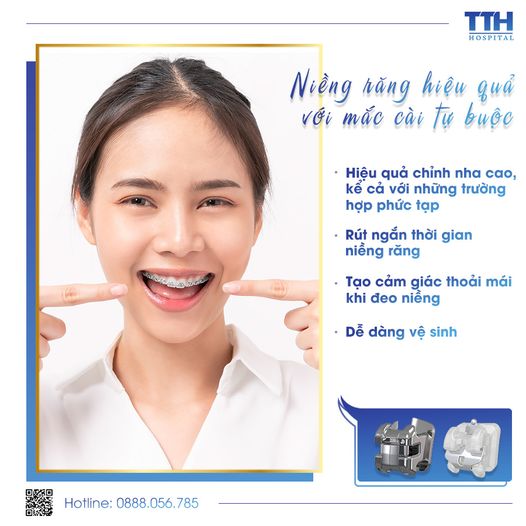 Niềng răng hiệu quả với mắc cài tự buộc