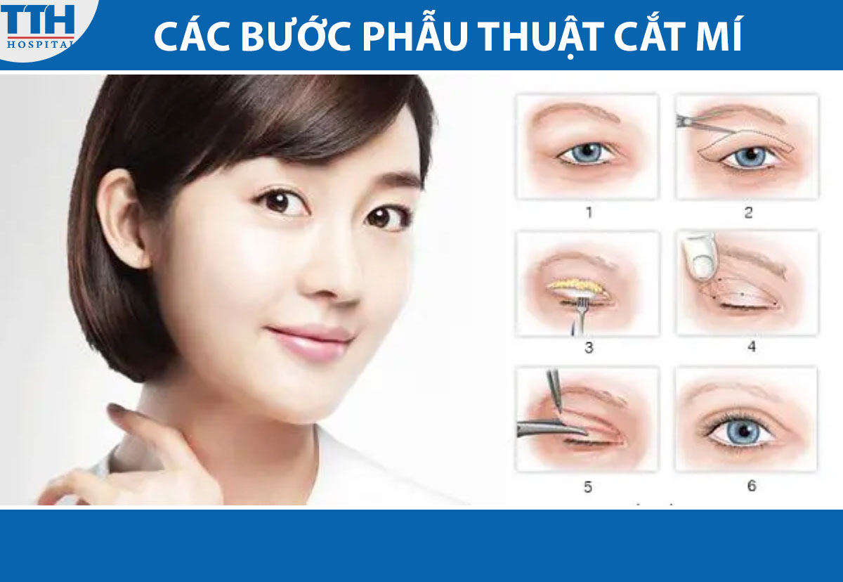 Phẫu Thuật Cắt Mí Mắt tại bệnh viện thái thượng hoàng