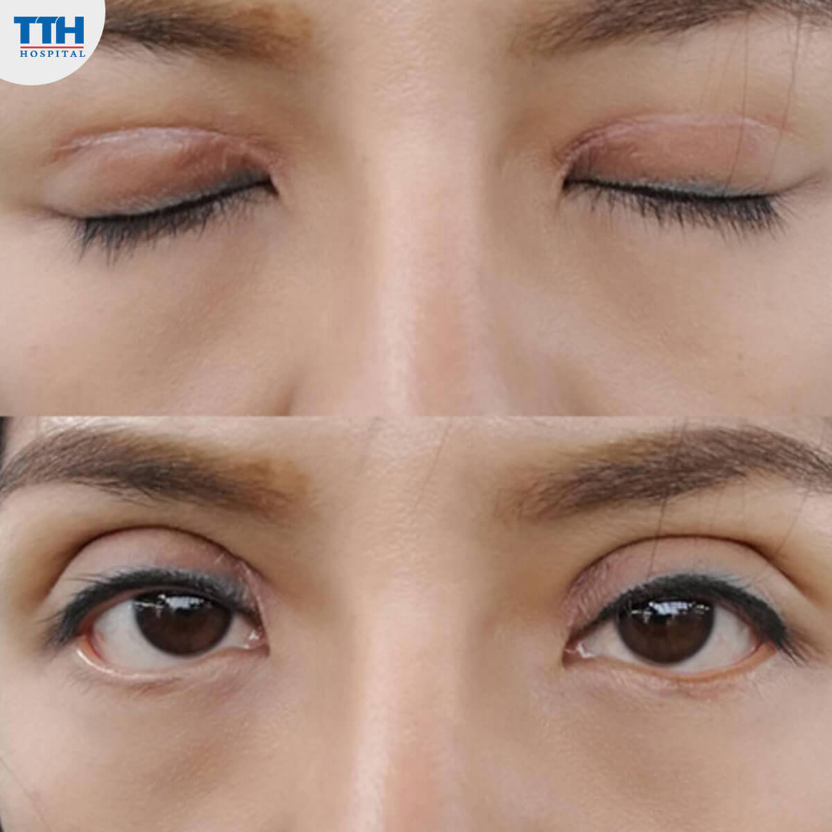 Chú ý vết sẹo sau cắt mí