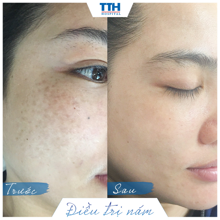 MỘT SỐ HÌNH ẢNH KHÁCH HÀNG SAU KHI LASER TRỊ NÁM Q-SWITCHED ND:YAG TẠI BỆNH VIỆN THÁI THƯỢNG HOÀNG