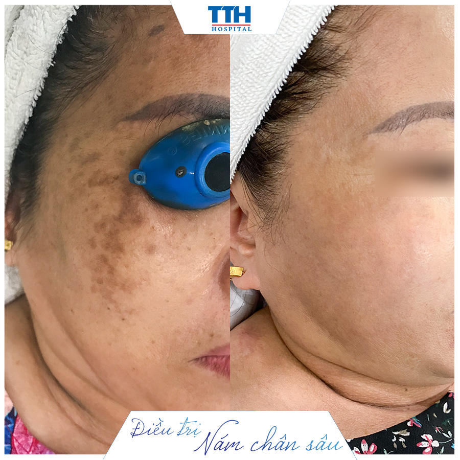 MỘT SỐ HÌNH ẢNH KHÁCH HÀNG SAU KHI LASER TRỊ NÁM Q-SWITCHED ND:YAG TẠI BỆNH VIỆN THÁI THƯỢNG HOÀNG 2