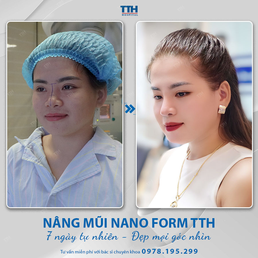 Nâng mũi là quyết định của bạn. Hãy chọn địa chỉ uy tín để an toàn và hiệu quả