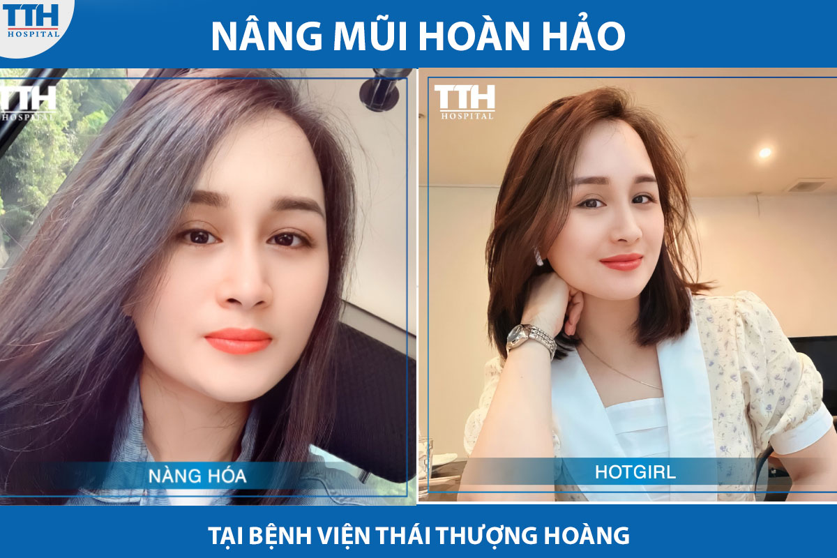 Thái Thượng Hoàng là địa chỉ nâng mũi uy tín được nhiều chị em lựa chọn khi mong muốn sở hữu gương mặt hoàn hảo