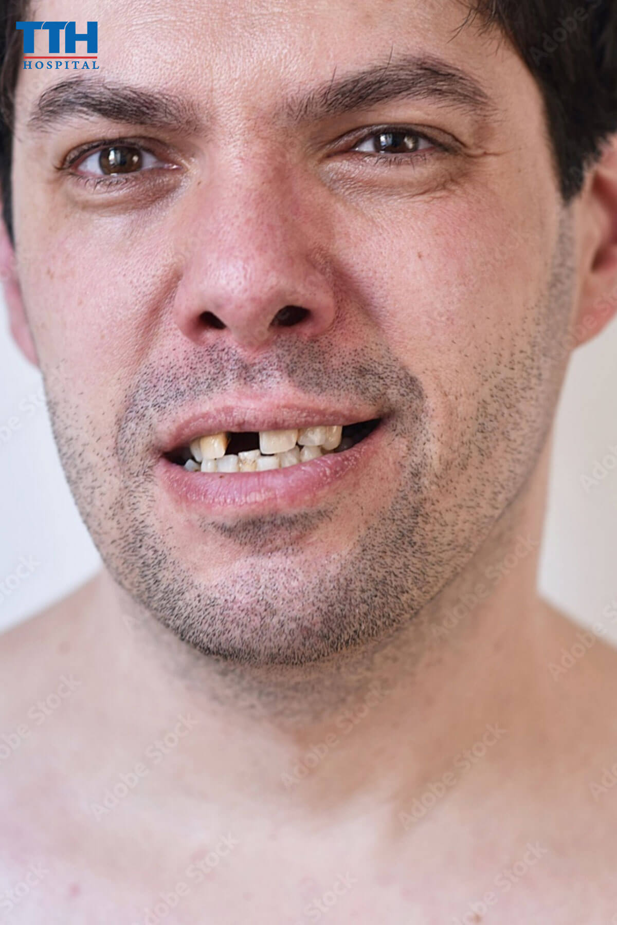  Chi Phí và Đối Tượng Phù Hợp của implant Straumann