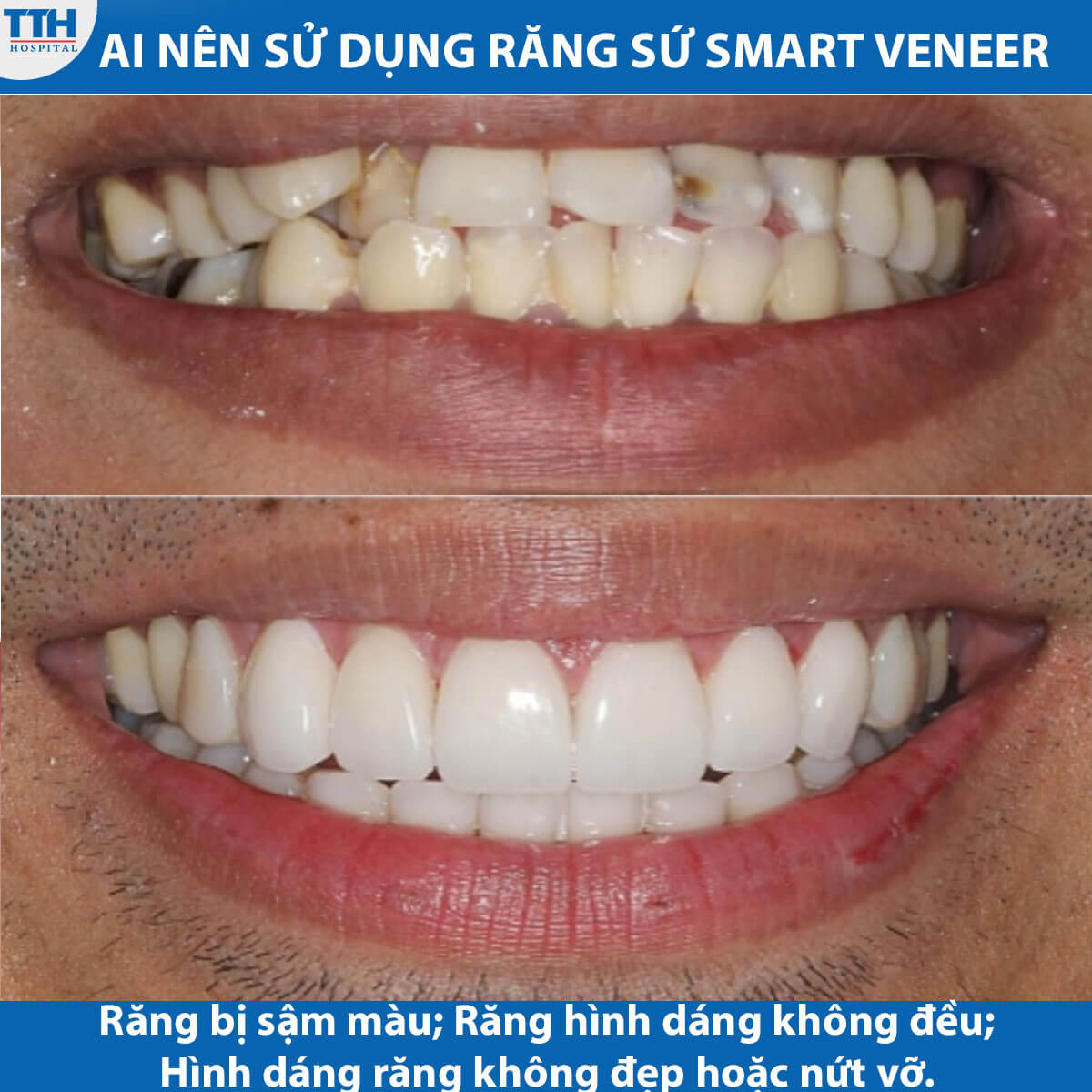 Ai nên Sử Dụng của Răng Sứ Smart Veneer?