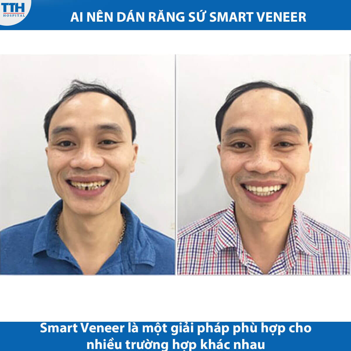 Ai là người nên làm dán răng sứ smart veneer