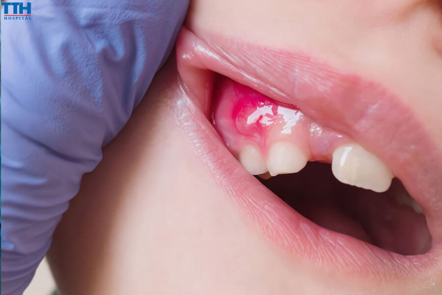 Áp Xe Tủy Răng Là Gì?