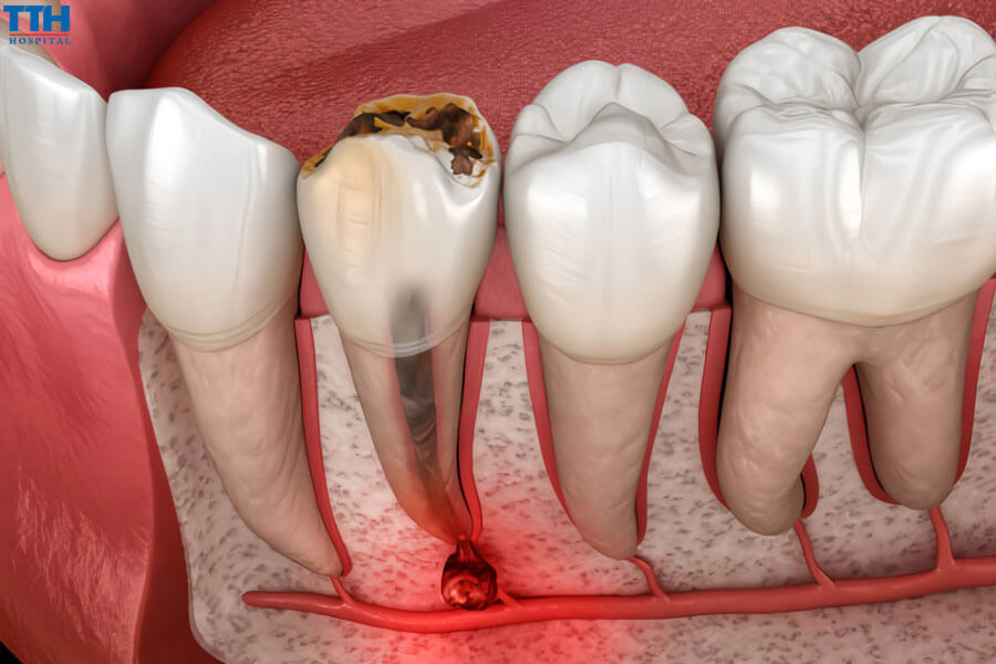 Áp-xe Tủy Răng