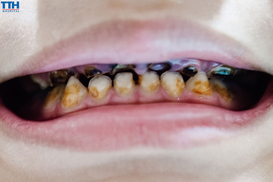 Bảo Vệ Sức Khỏe Răng Miệng cho trẻ em