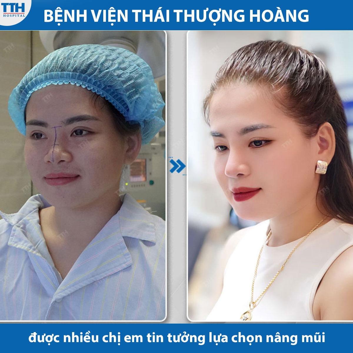 Bệnh viện Thái Thượng Hoàng được nhiều chị em tin tưởng và lựa chọn để thực hiện nâng mũi