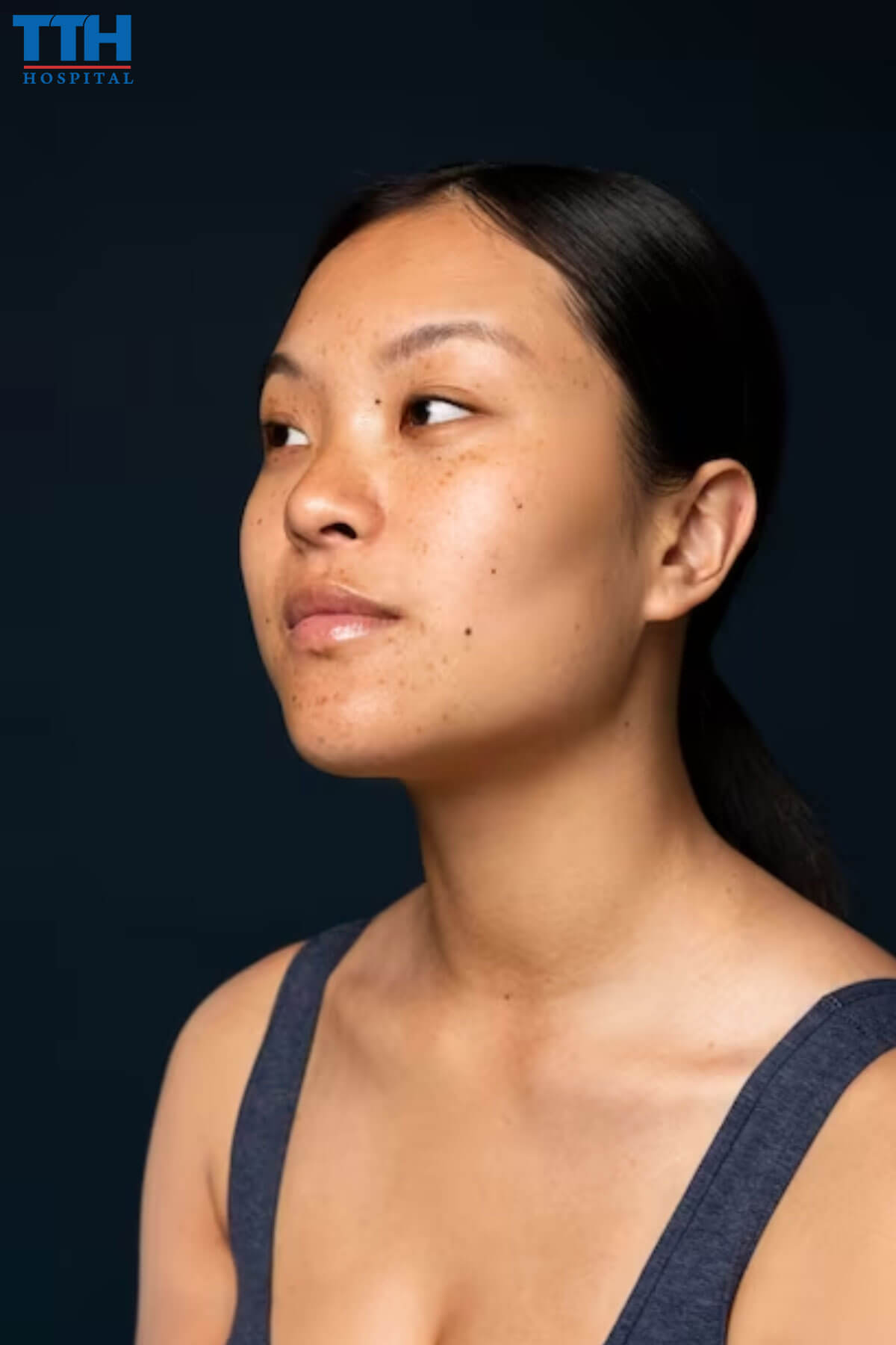 Biểu hiện của nám chân sâu trị nám tại Vinh, Nghệ An