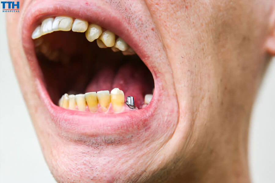 Không quan tâm đến việc điều chỉnh cắn khớp sau khi gắn mão răng sứ.