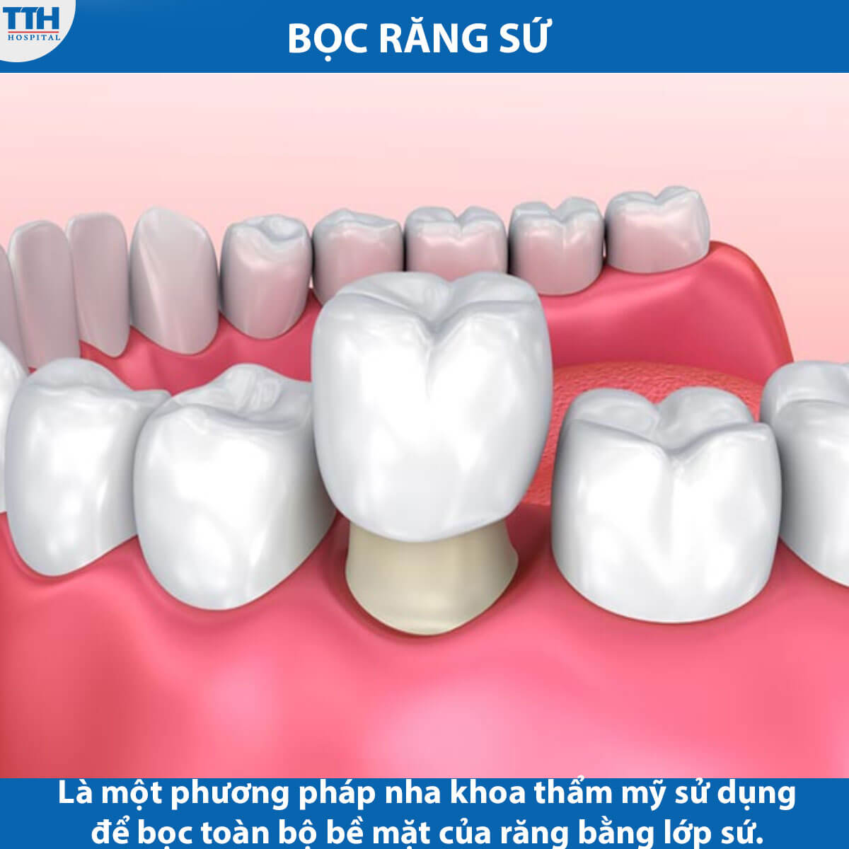Bọc răng sứ là gì