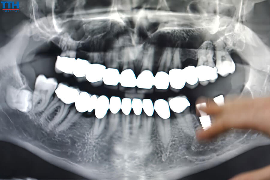 Các kỹ thuật cải thiện chất lượng xương hàm