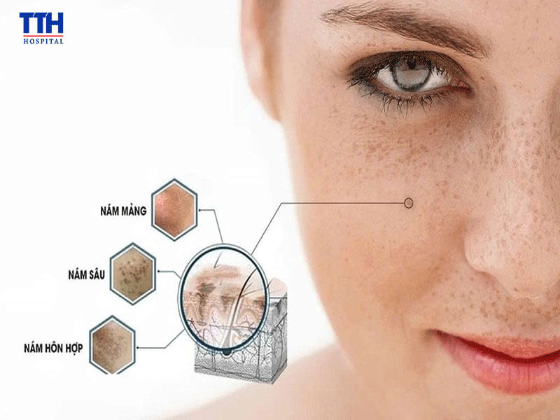 Các loại nám thường gặp