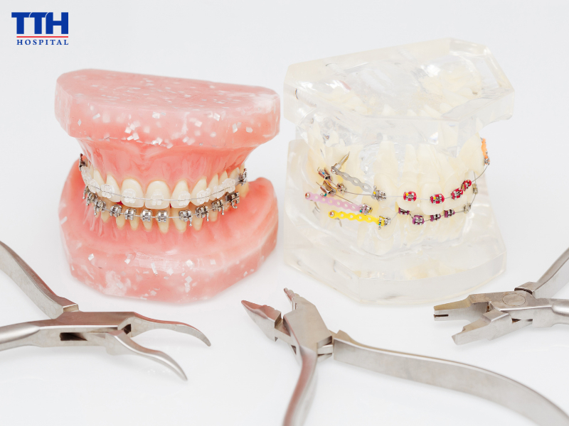 Cách vệ sinh răng đúng khi niềng