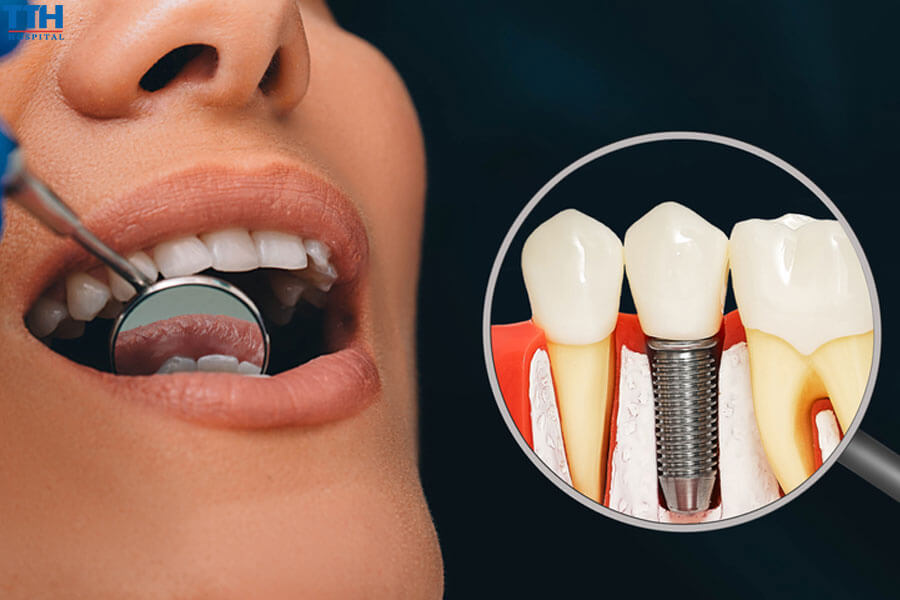 Cách xử lý khi răng implant bị lung lay