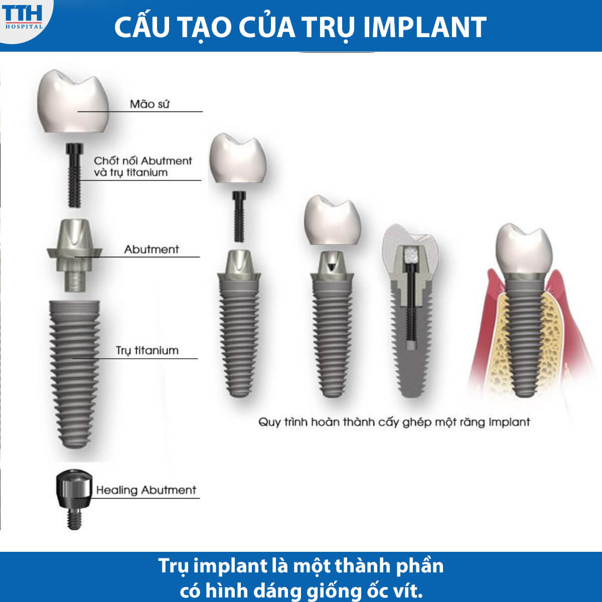 Cấu tạo trụ implant