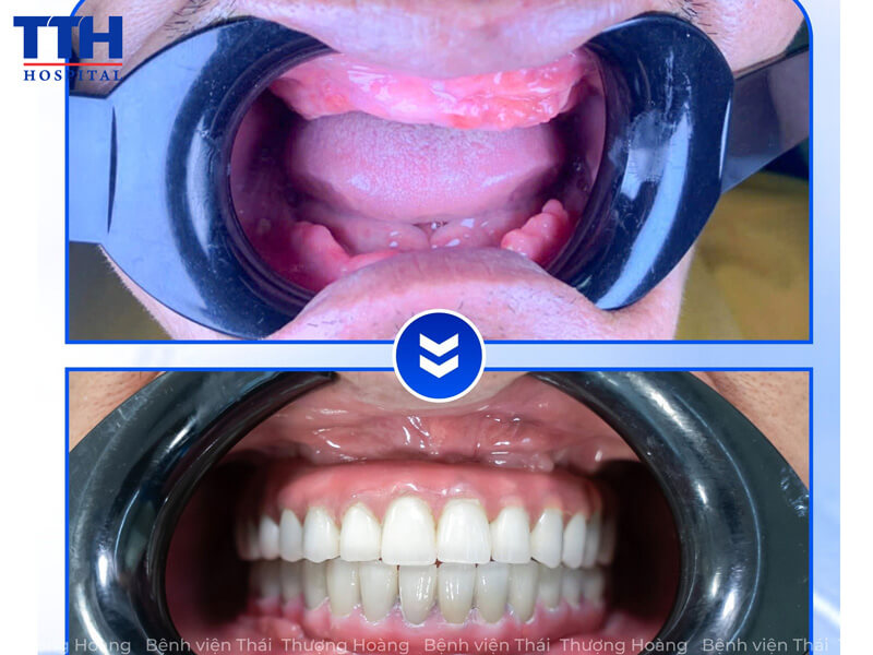 Cấy ghép implant – không chỉ là phục hình, mà là “người bạn đồng hành” lâu dài