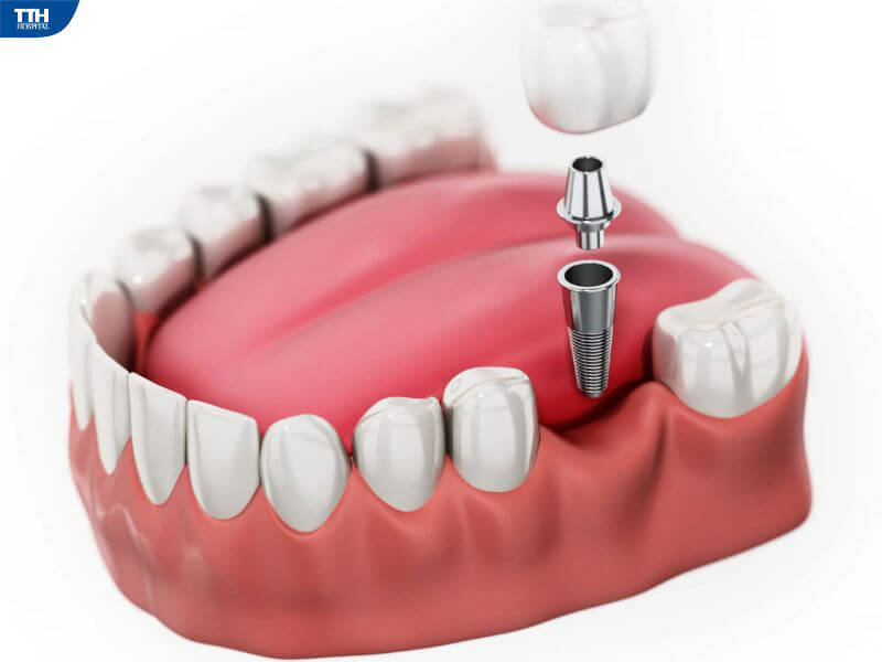 Cấy ghép Implant là gì?