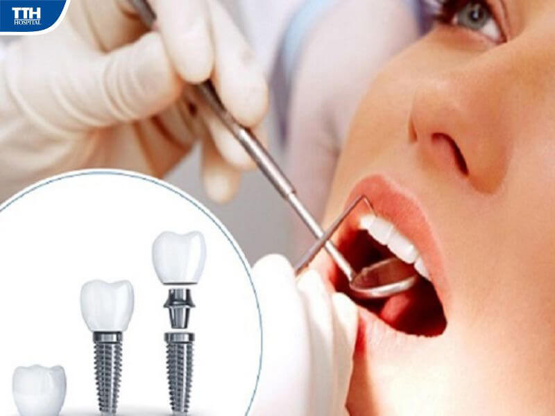 Cấy ghép implant toàn hàm áp dụng cho trường hợp nào?