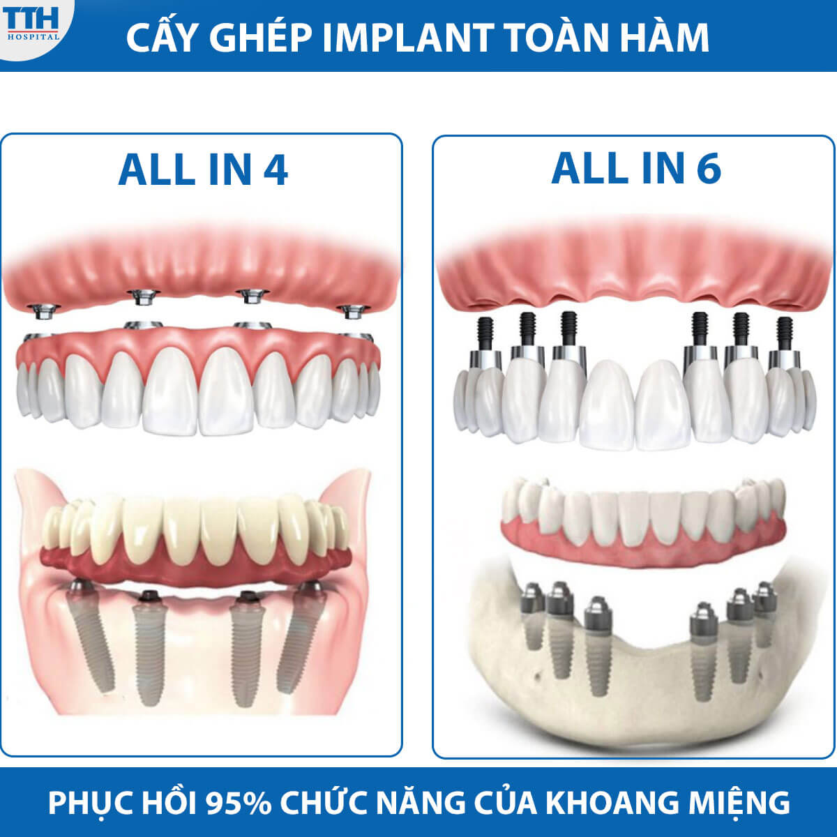 Cấy ghép implant toàn hàm