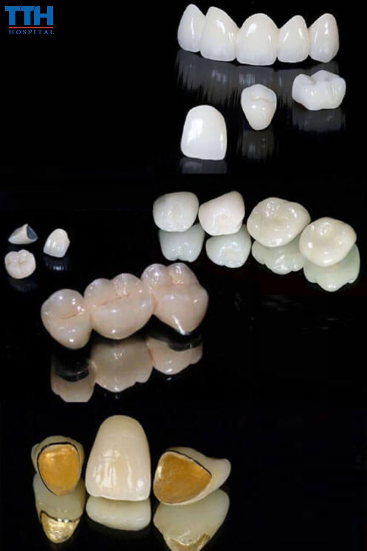 Chi Phí Bọc Răng Sứ phụ thuộc vào chất liệu sứ tại Vinh, nghệ an