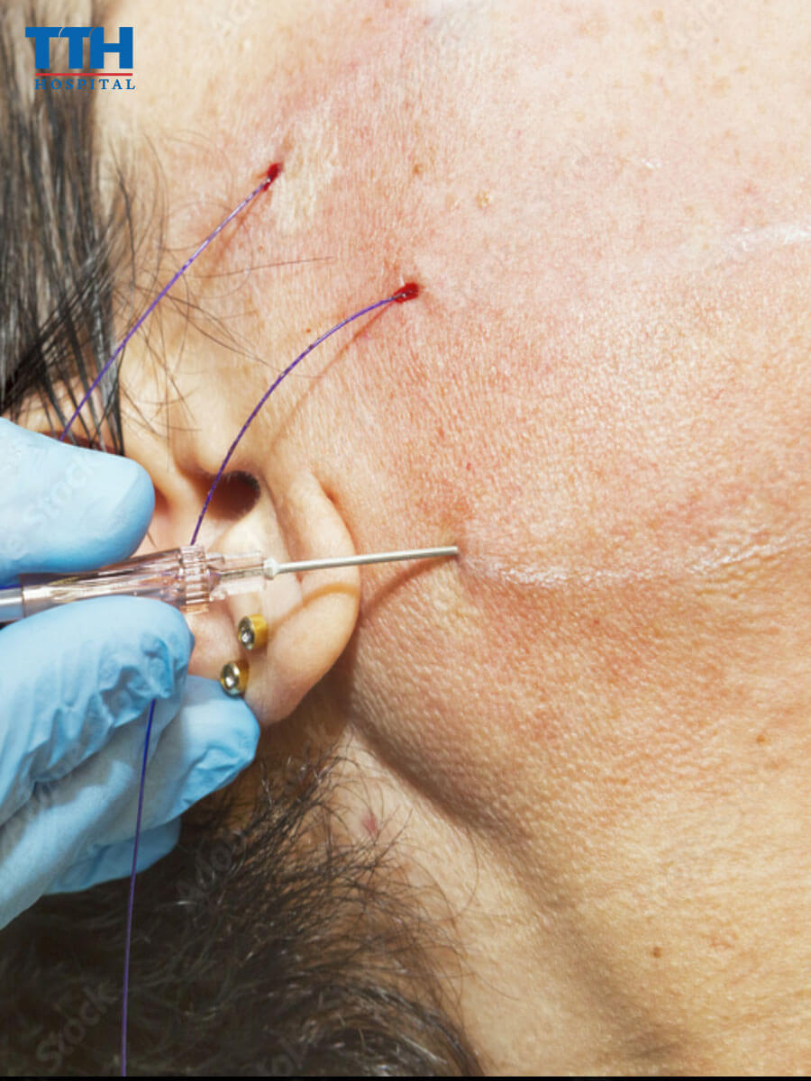 Chỉ sinh học Xline là gì?