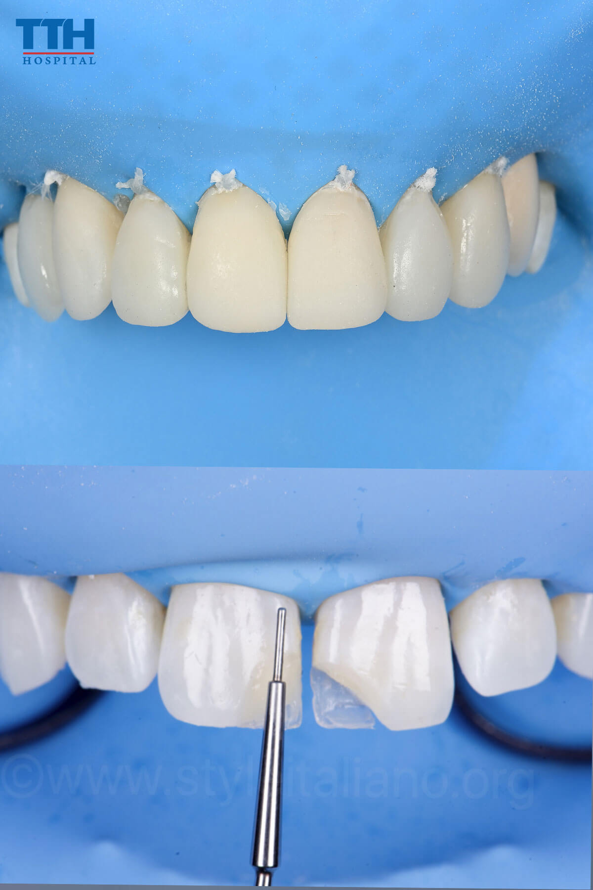 Răng Sứ Composite