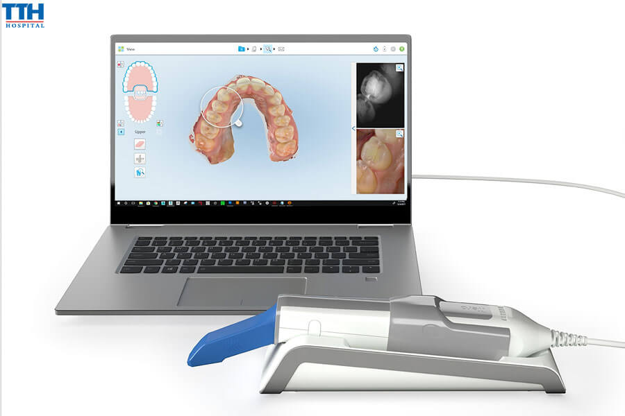 Công Nghệ Quét Dấu Răng ITERO 5D