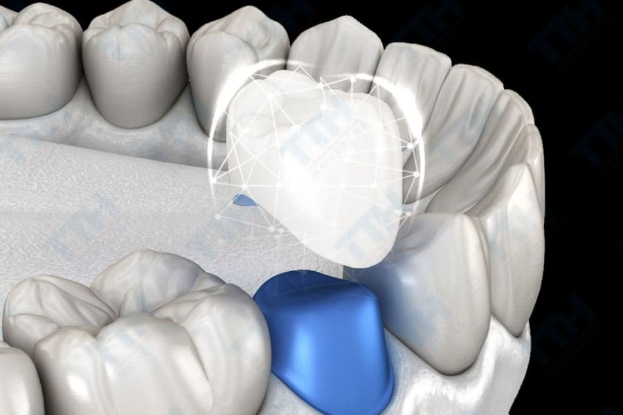 Đặc điểm nổi bật của Răng Sứ Orodent Bleach Innovation