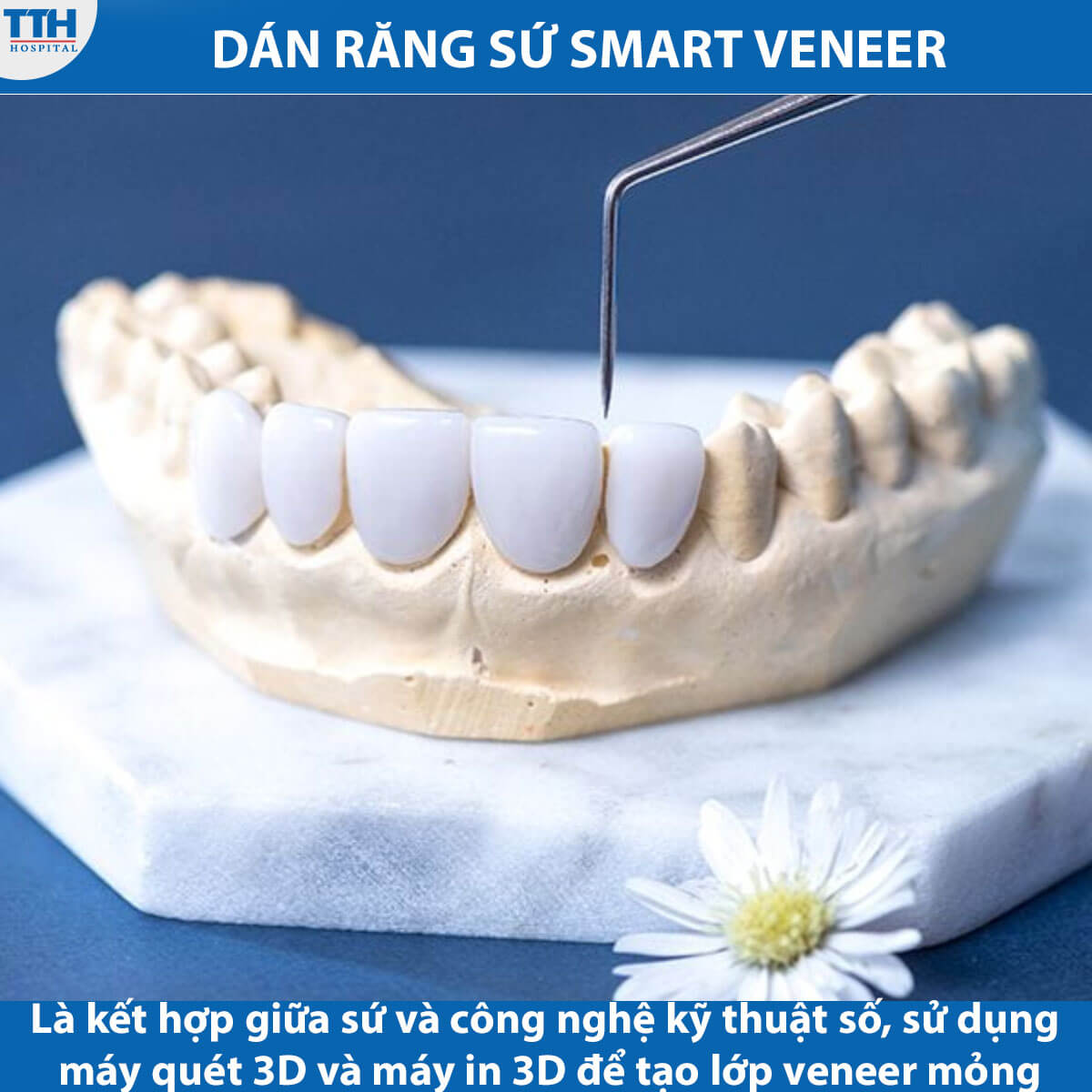 Dán Răng Sứ Smart Veneer