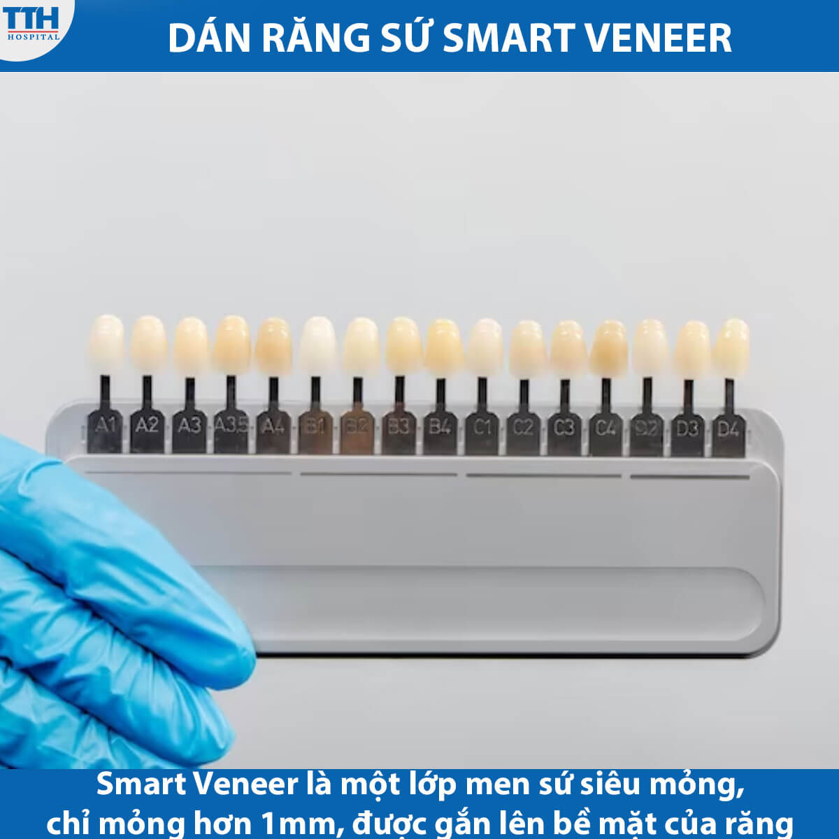 Dán răng sứ Smart Veneer