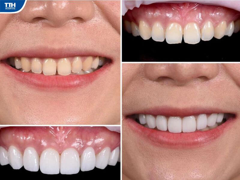 Dán sứ veneer là gì?