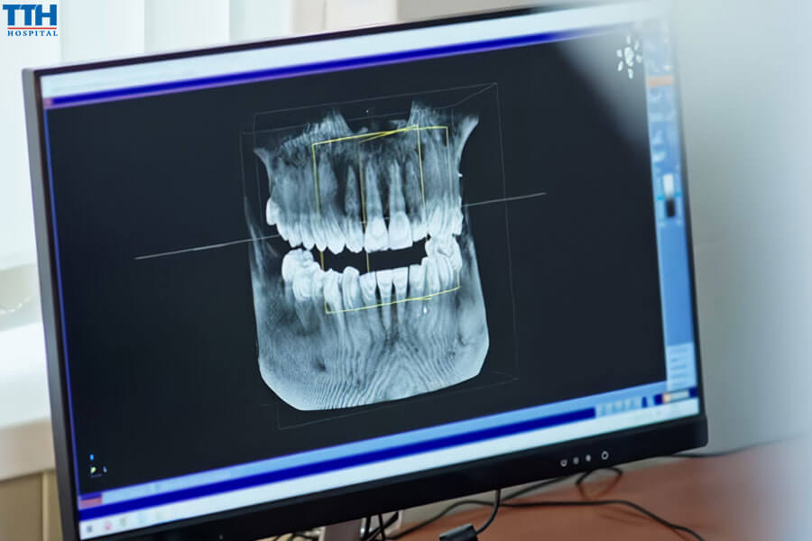 Đánh giá sức khỏe xương hàm trước khi trồng răng implant