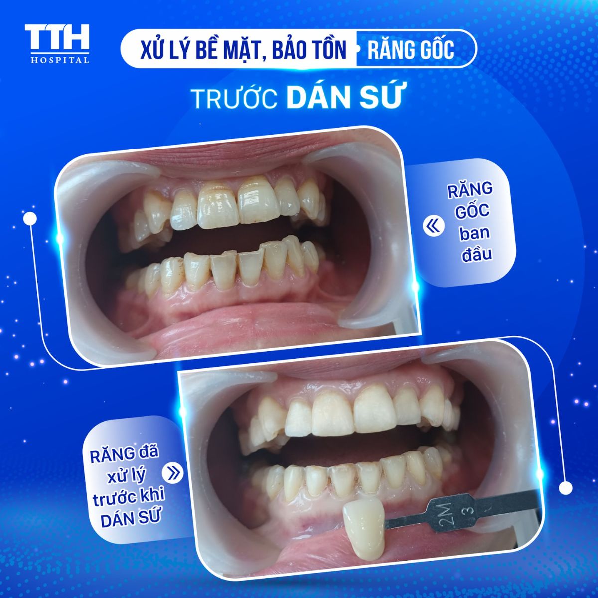 Dán sứ TTH Veneer không xâm lấn