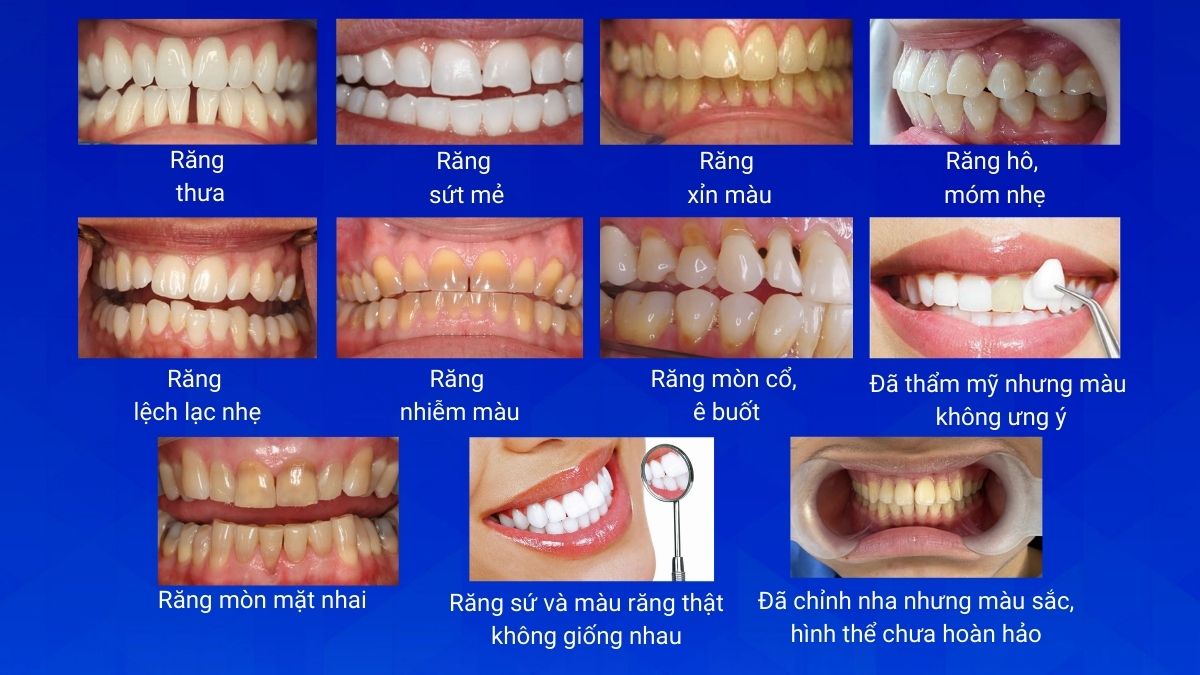 Đối tượng phù hợp với dán sứ TTH Veneer