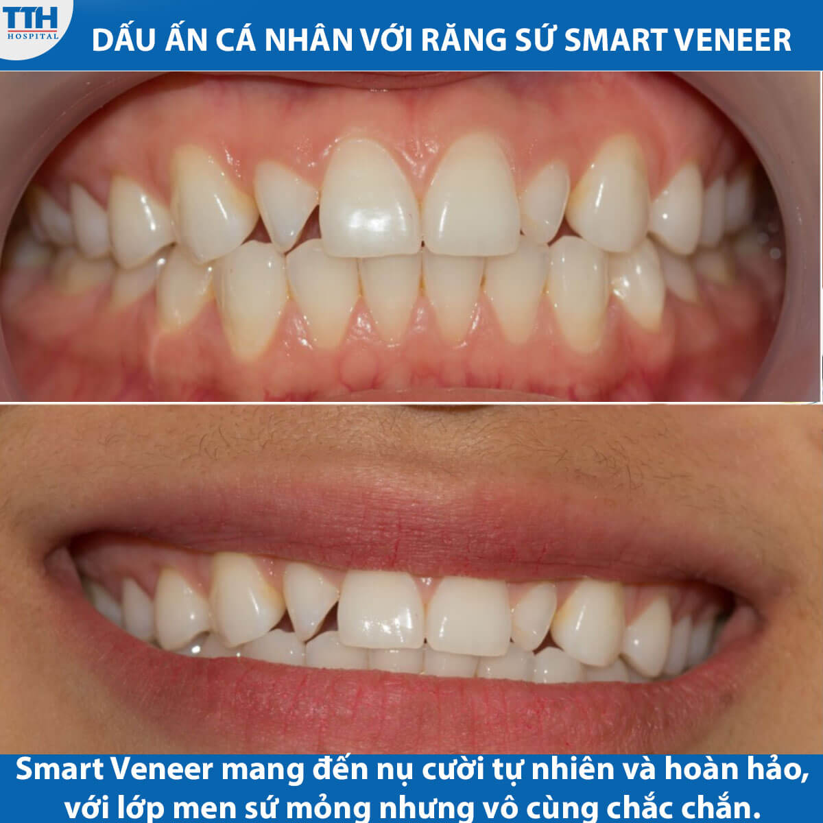 Dấu ấn cá nhân với răng sứ Smart Veneer